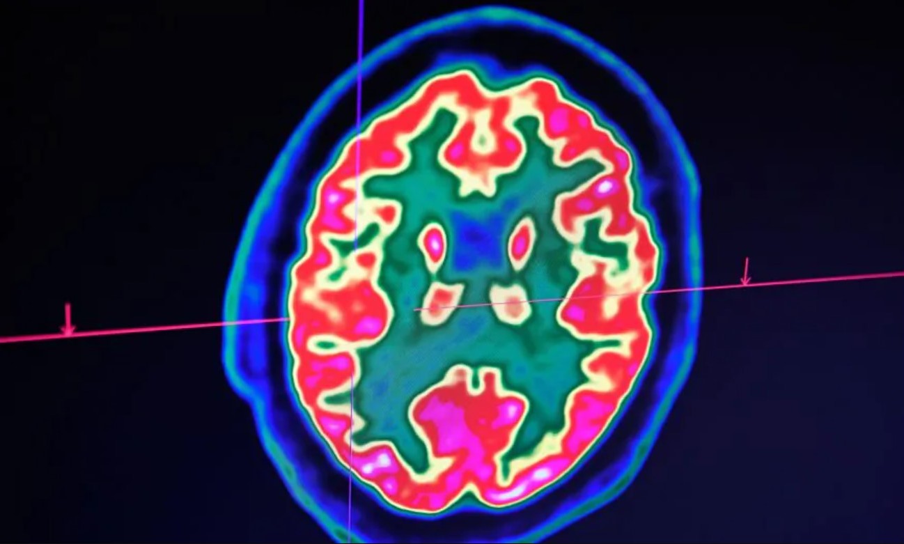 Vědci objevili příčinu Alzheimerovy choroby na molekulární úrovni.